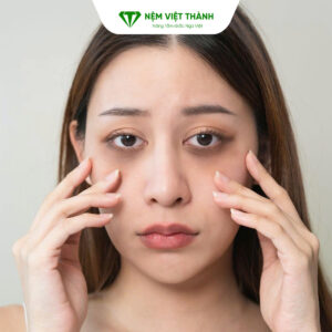 Thiếu ngủ là nguyên nhân chính dẫn đến thâm mắt Thiếu ngủ là nguyên nhân chính dẫn đến thâm mắt