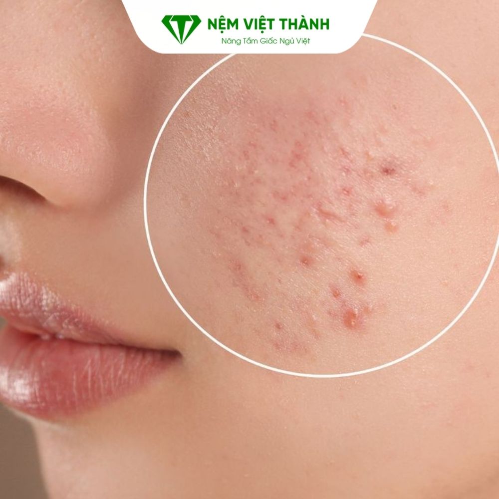 Làm tăng nguy cơ nổi mụn trên da nếu không vệ sinh nệm thường xuyên Làm tăng nguy cơ nổi mụn trên da nếu không vệ sinh nệm thường xuyên